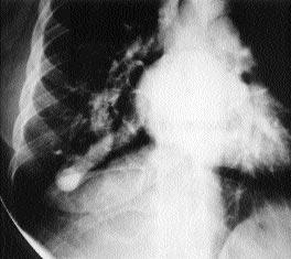 MRA ile özellikle koronal düzlemde elde edilen gradyent eko görüntülerde sağ pulmoner arterde lümeni oblitere eden emboli izlendi.