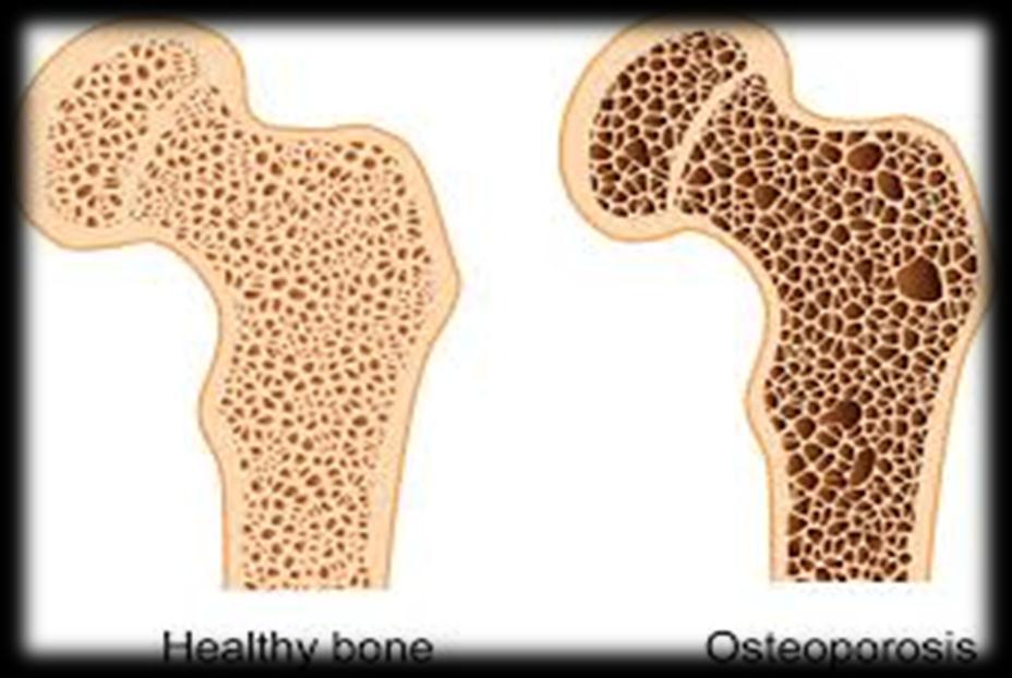 Kemik yapılar Osteoporozdan dolayı