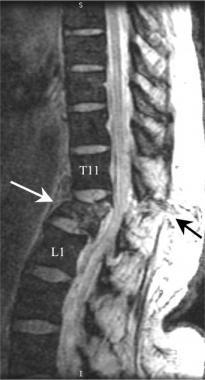 Torakolomber Vertebra Yaralanmaları T12-L1 ve T7-T8 bölgesi en sık fraktür bölgeleridir En sık anterior kompresyon fraktürü