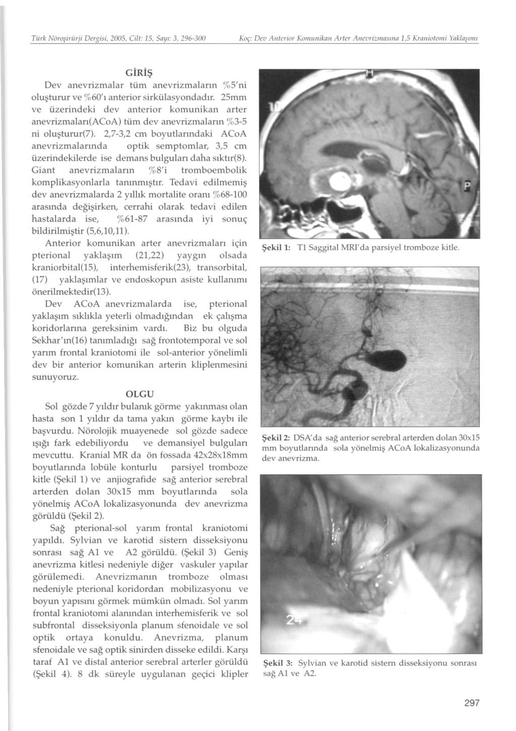 Türk Nörosiriirji Dergisi, 2005, Cilt: 15, Sayi: 3, 196-300 Koç: Dev Aiiterior Koiiiiiiiikaii Arter Aiievrizninsiiin 1,5 Kraiiiotoiiii Yaklasmll GIRIs Dev anevrizmalar tüm anevrizmalarin %5' ni