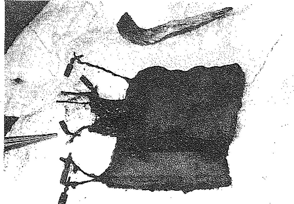 Sonra kaıtilaj greft alıcı bölgeye sütüre edildi. Flebin damar pedikülü sağ inguinal bölgeye bir subkütanöz tünelden geçirildi. Daha önceden hazırlanmış olan a.profımda femoris, a.radialis'e, v.