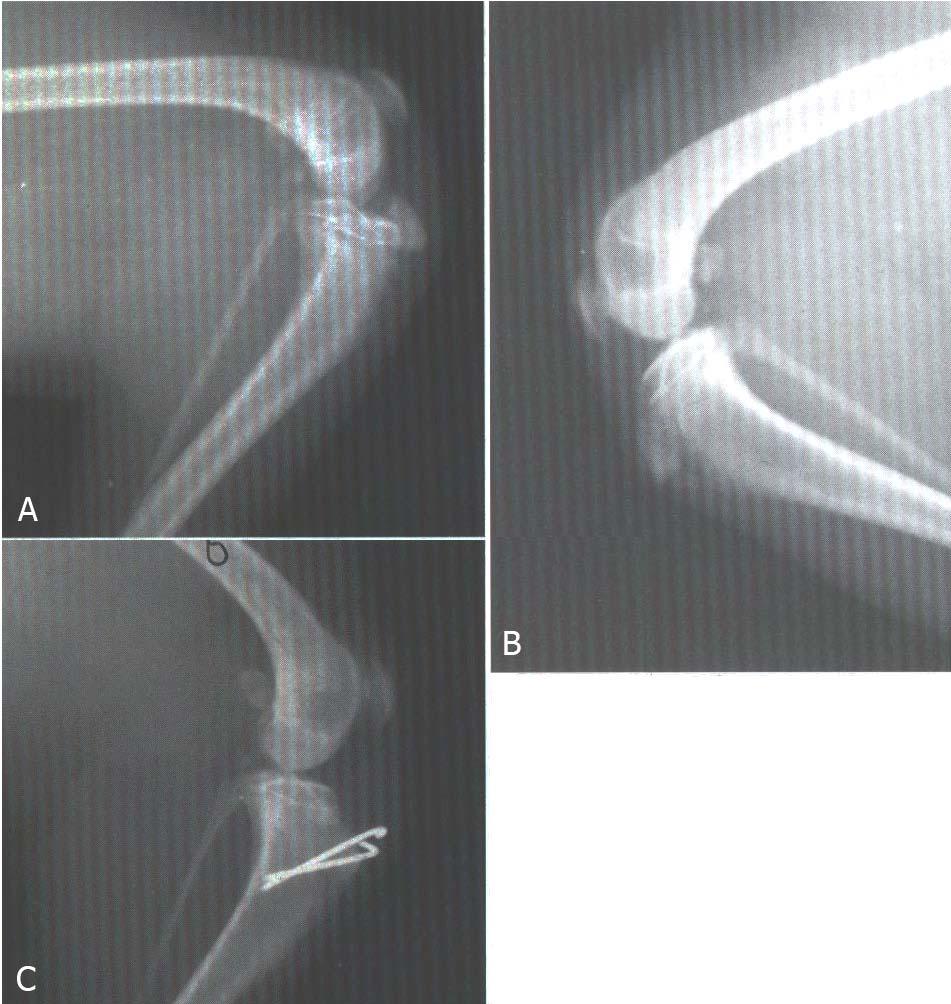 33 Şekil 1.8. A) Tuberositas tibiae nın apofizyolizisi, B) Tuberositas tibiae nın normal görünümü, C) Tuberositas tibiae nın apofizyolizisinin iki Kirschner teli ile fiksasyonu (Brüse, 1998). 1.6.4.