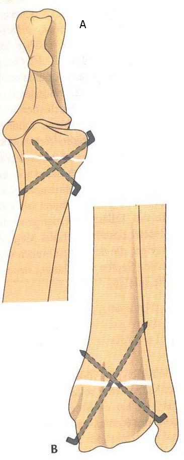 38 Şekil 1.13. A-B) Proksimal ve distal radius ta Salter-Harris Tip I kırığının çapraz pin rekniği ile fiksasyonu (Johnson ve Hulse, 2007).