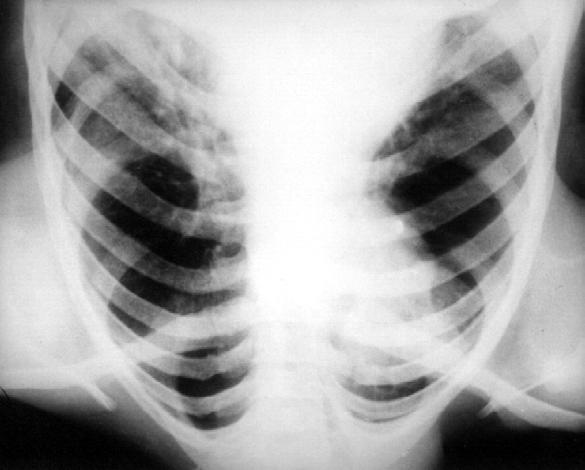 Şekil 21.Sol alt lobda yer alan intralobar pulmoner sekestrasyonlu diğer bir vakamıza ait aortografide sekestre dokunun abdominal aortadan çıkan iki arter ile beslendiği görülmektedir. Şekil 22.