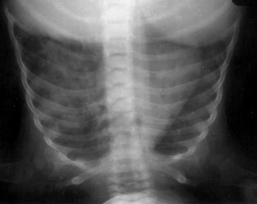 A B C1 C2 D Şekil 24. Bronkojenik kist ön tanısı ile ameliyata alınan bir hastamıza ait P-A(A) ve yan akciğer gr.de(b) bronkojenik kist izlenmektedir.