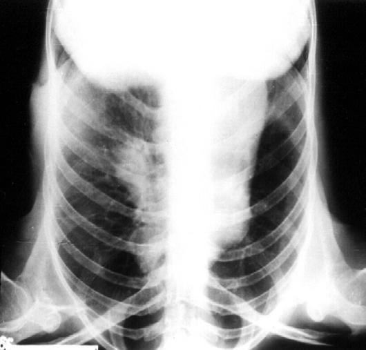 A B C D Şekil 29. Konjenital izole sol pulmoner arter (PA) yokluğu olan 19 yaşındaki bayan hastamızın P-A (A), ve sol yan akciğer grafisi (B). Sol tarafta vaskülaritenin olmadığı dikkat çekmektedir.