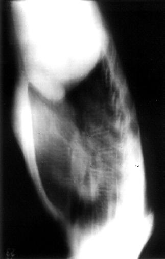 Selektif PA anjiografisinde sol pulmoner arterin bulunmadığı, ana ve sağ PA dallarında anevrizmatik dilatasyonlar izlenmektedir (D). dadır[145]. anomalilere rastlanmaktadır[147].