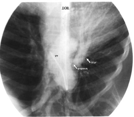 Buna göre: si sonucu oluştuğu kabul edilmektedir[145,147,150] genellikle 1- Santral stenozlar: Stenoz, ana pulmoner arter ve/veya sağ ve aortik arkusun karşı tarafındaki pulmoner arter yoktur.