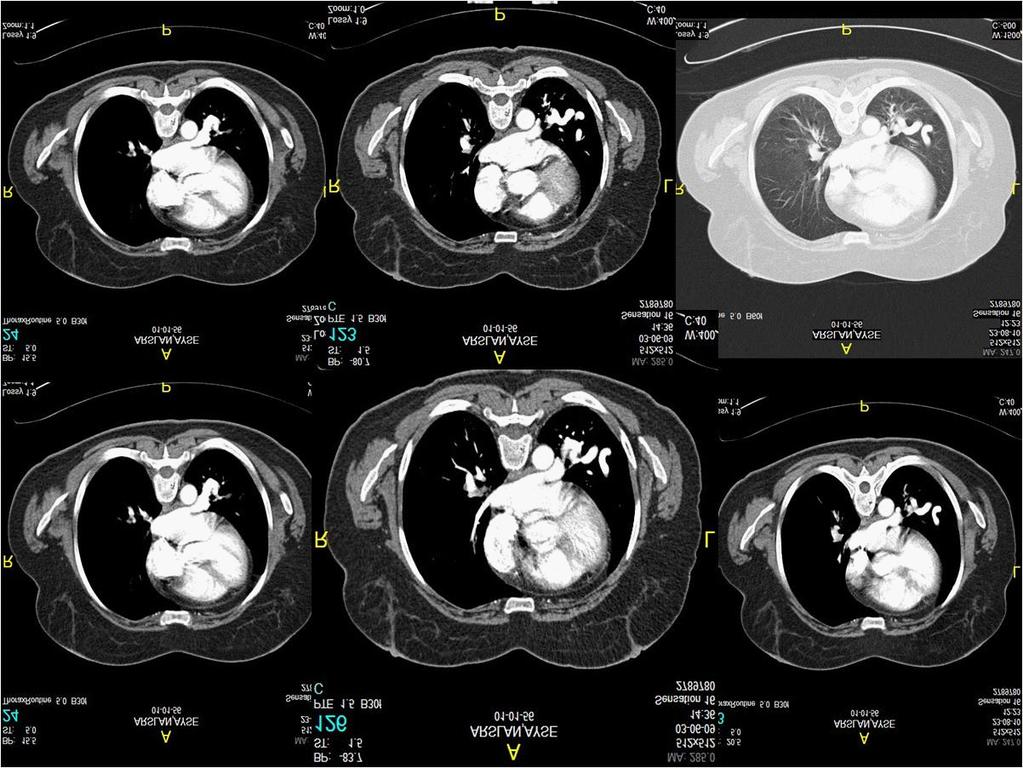 Şekil 40. İzole pulmoner varisli bir hanım hastamıza ait toraks BT de sol alt lobda yer alan pulmoner varis izlenmektedir. mektedir[171,172].