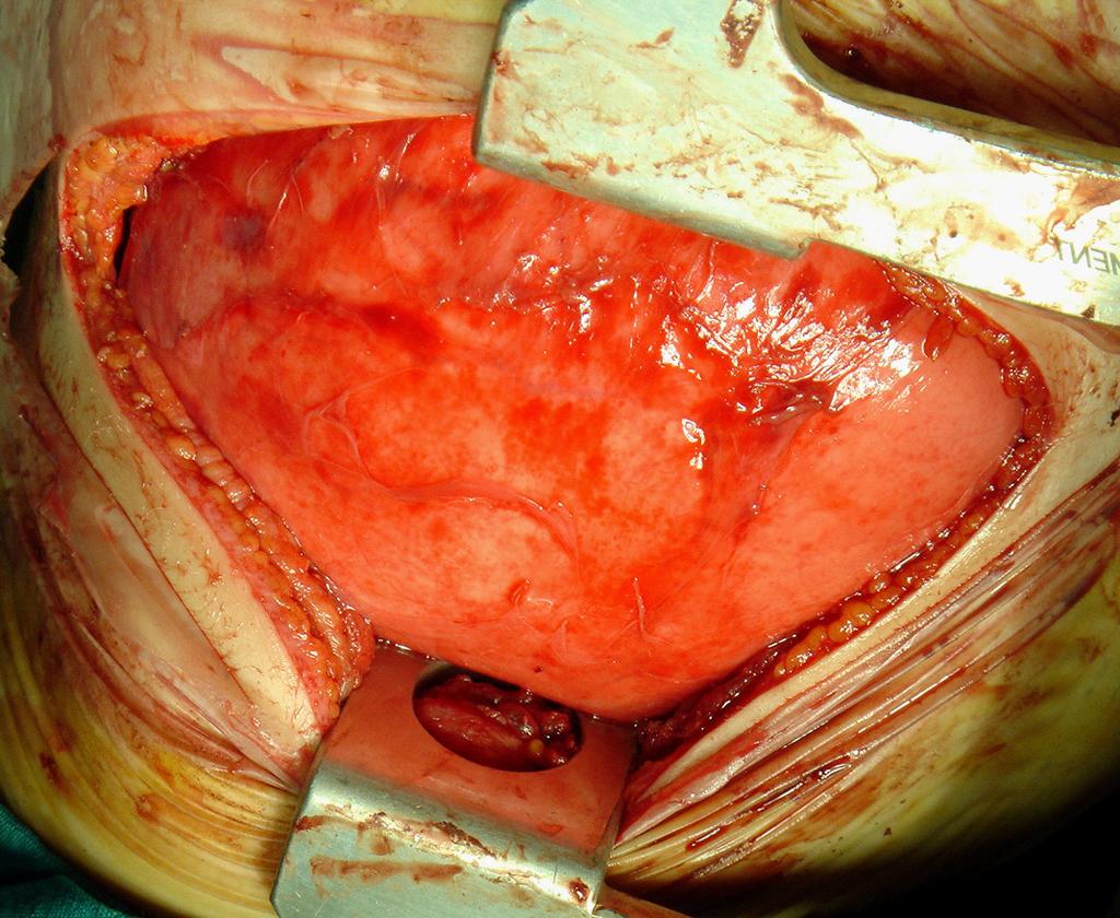 Sık görülen normalden fazla fissür anomalilerinden biri sol akciğerde, lingulanın üst lobun diğer segmentlerinden bir fissür ile ayrılması ile oluşan sol akciğerin trilobülasyonudur (Şekil 3).
