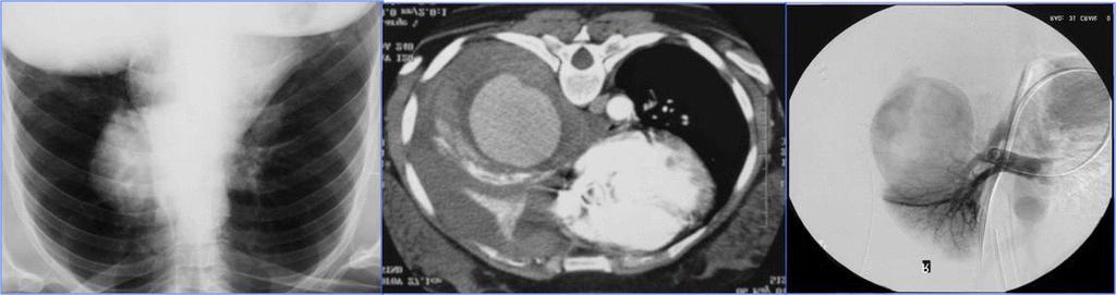 Bir çocuk hastamıza ait bilateral, alt loblarda yerleşim gösteren PA anevrizmasının