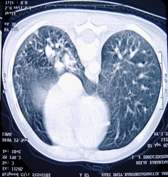 desendan seyirli Scimitar veninin akciğer grafisi (A) ve kontraslı