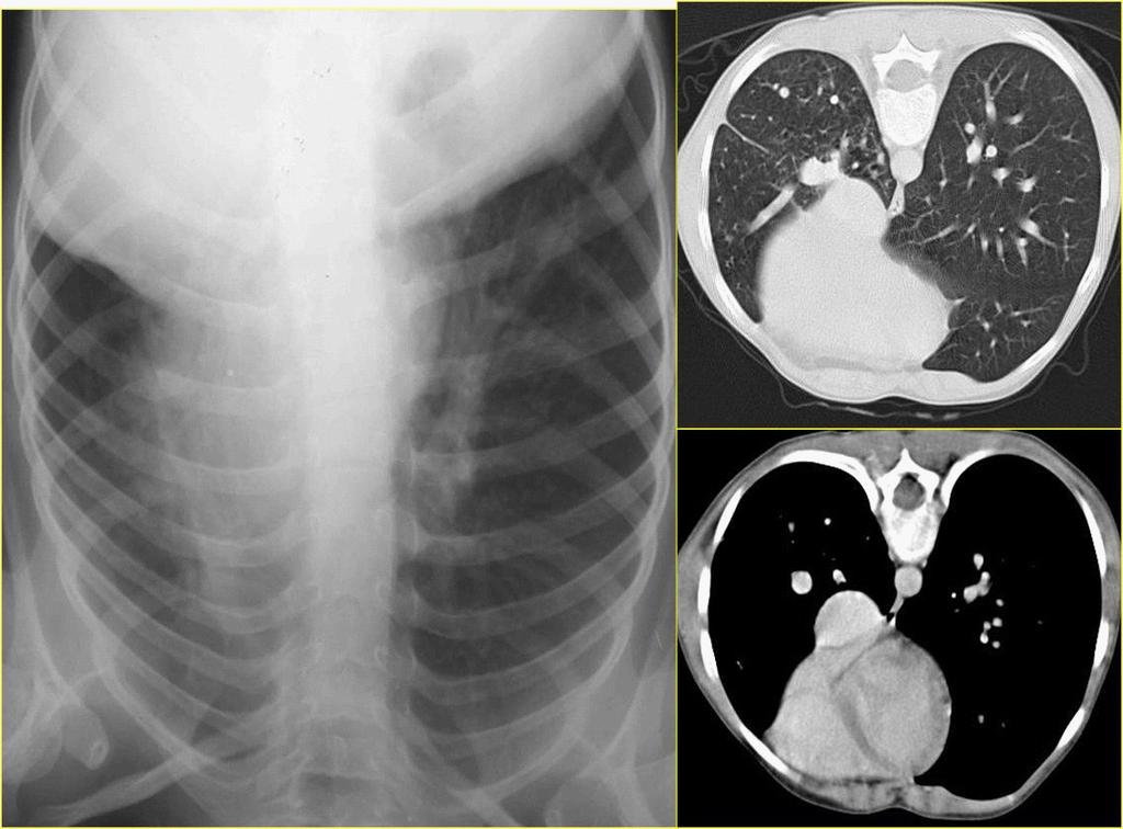 düzeltme yapılan bir hastamızın akciğer grafisinde abdominal situs