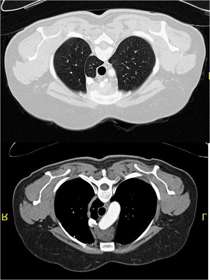 Şekil 6. Azygos fissürünün akciğer tomografisinde mediasten ve parankim penceresinde görünümü bronşlar özefagustan çıkarlar(şekil 7).
