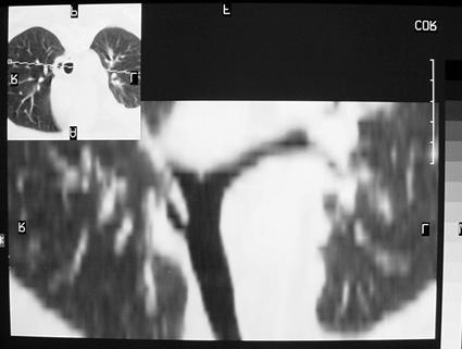 Eskiden sadece otopside tarif edi- lirken günümüzde multidetektör komputerize tomografi ve fiberoptik bronkoskopi ile daha kolay tanı konabilmektedir[25].