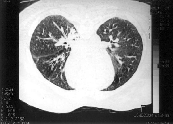 Şimdiye kadar bildirilen vakaların hepsinde fistül karaciğerin sol lobu ile iştiraklidir. Fistülün ligasyonundan sonra karaciğerin sol lobunun küçüldüğü görülmektedir[48].