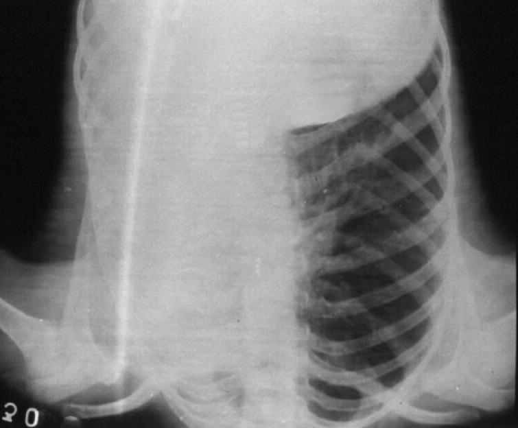 Embriyonik akciğer tomurcuklarından birinin gelişmemesi sonucu ortaya çıkan bu anomalide akciğere ait bronşial, vasküler ve parankimal hiçbir doku yoktur. Say ve ark.