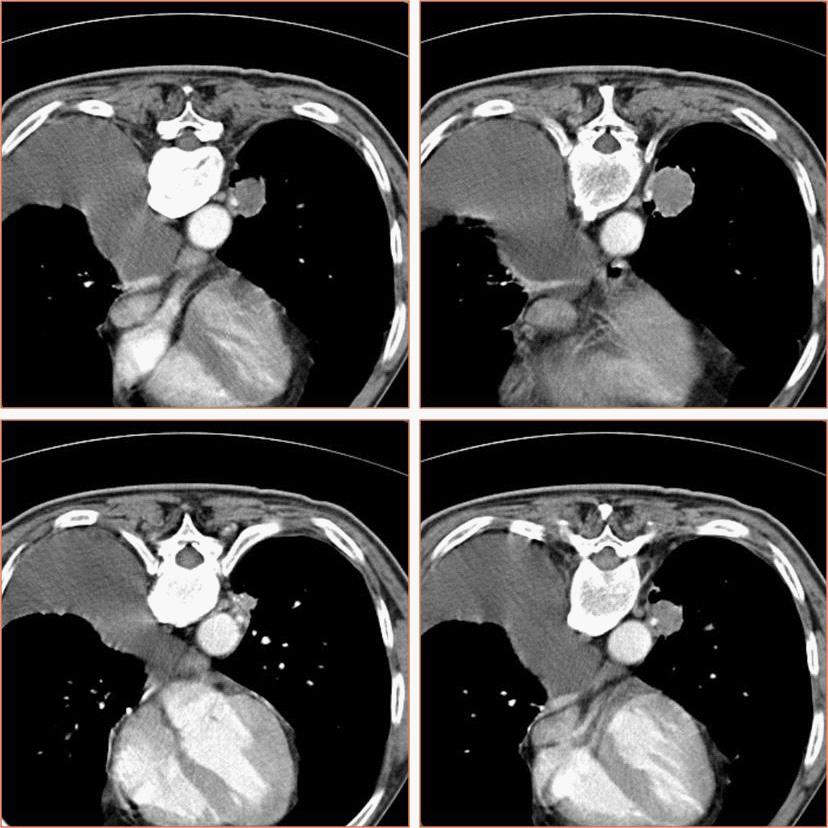 Tablo 3. Sekonder pulmoner hipoplaziye eşlik eden patolojiler( Luck SR(69) den alınmıştır).