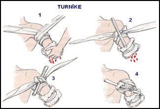 Yani turnike kolda dirsek ile omuz, bacakta ise kasık ile diz arasında yapılmalıdır. Turnike uygulandıktan sonra her 15-20 dakikada bir mutlaka gevşetilmelidir.