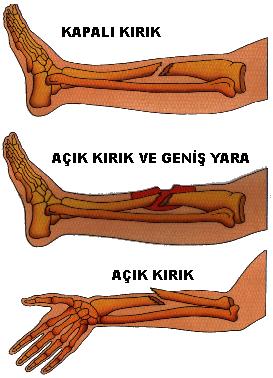 Kırıklar Kırık vücuttaki kemiklerden bir veya birkaçının herhangi bir etki sonucunda bütünlüğünün bozulması olayıdır. Kırıkla birlikte çoğunlukla yarada oluşur.