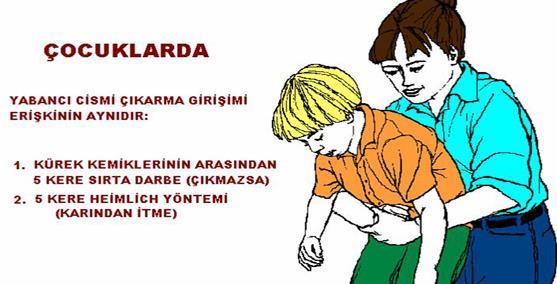 Bilinci yerinde tam tıkanıklık olan kişilerde Heimlich Manevrası (=Karına bası uygulama) nasıl uygulanır?