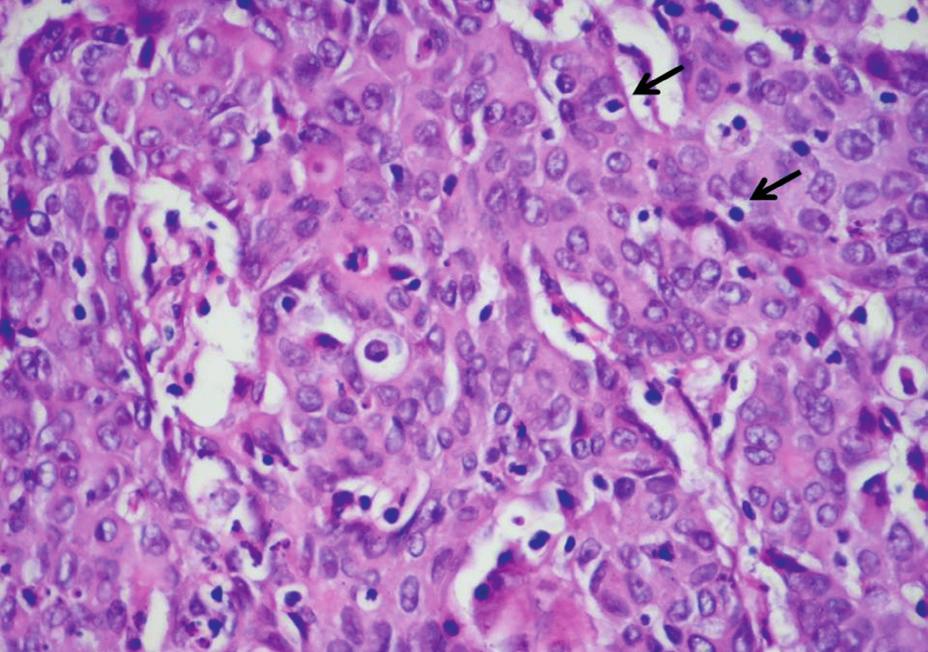 DOĞANAVŞARGİL ve ark. Resim 1: Tabakalar şeklinde, solid büyüme gösteren tümör (*). Solda normal kolon mukozası görülüyor. Tümörde glandüler diferansiyasyonun olmaması dikkat çekici.