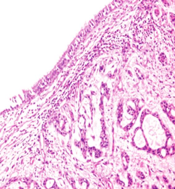TARTIŞMA Trakeobronşiyal adenoid kistik karsinomlar (AKK), havayollarında submukozal alanda yer alan bronşiyal sekretuar hücrelerden köken alır.