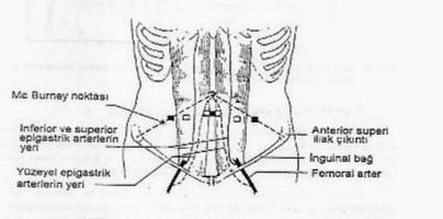 Kateter tercihan rectus