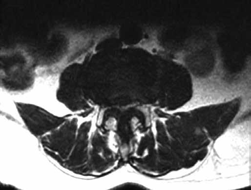 L5-S1 foramen/kök alanı oranı daha küçük olduğu için foraminal darlık L5 sinir kökünü daha sık içerir (13). Şekil 2: Dar kanal, aksiyel MR görüntüsü.