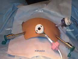 Ro ot Yardı lı Laparoskopik Cerrahi İpuçları Tips & Tricks Foley kateter e