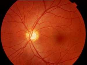 oranı ise 0.5 düzeyindedir (b). b Resim 2. Fundus floresein anjiyografisinde sağ gözde retinal iskemiye rastlanmadı. Resim 3.