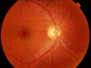 Antifosfolipid sendromuna bağlı edinsel trombofili ise retinal ven tıkanıklığı için kesinleşmiş bir risk faktörüdür.