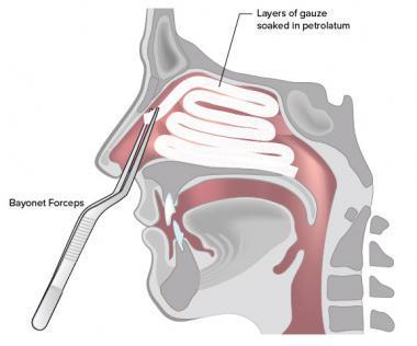 21 GÖZ VE KBB PROSEDÜRLERI Nazal Tampon Yerleştirilmesi Epistaksis kliniğinde