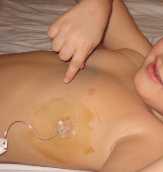 profilaksi sorunsuz 7 yaşında port kateter yenilendi