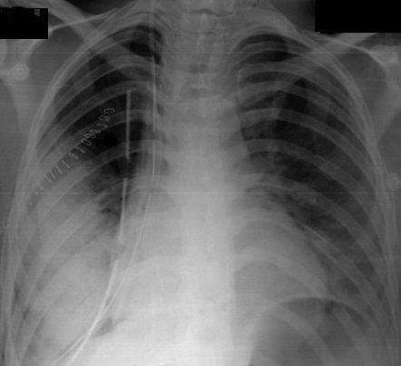 Reekspansiyon Akciğer Ödemi Resim 1. Pnömotorakslı hastada tüp torakostomi sonrası sağda reekspansiyon akciğer ödemi.