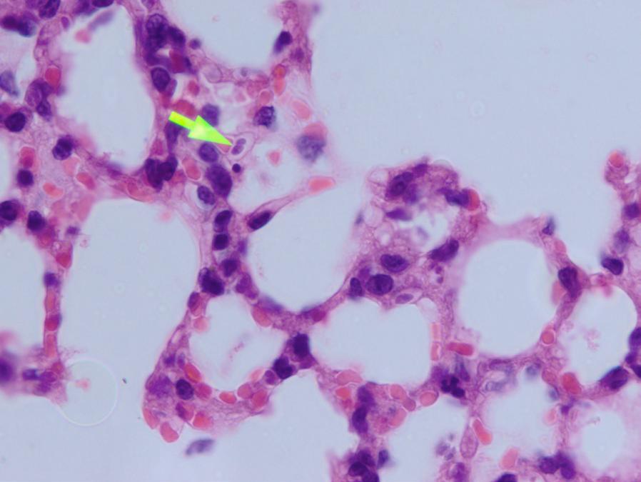Cilt 72 Sayı 1 2015 T. GONDII PATHOGENESIS IN MICE Figure 4. Toxoplasma parasite in alveolar capillaries (H-E X1000) Figure 5. Necrotic foci and Toxoplasma parasites in the liver (H-E X400) Figure 6.