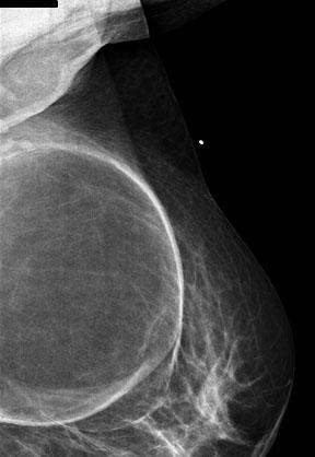 Şekil 1B : Sol meme mlo mamografi Hastanın meme ultrasonografisi sol meme dış kadranda 15x11 cm, düzgün sınırlı, kapsüllü, yağ dokusu ekojenitesinde nodüler lezyon (kas içi lipom?