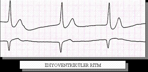 Nabızsız Elektriksel aktivite = Elektromekanik Disosiasyon * kalpte elektriksel aktivite (+) * yeterli