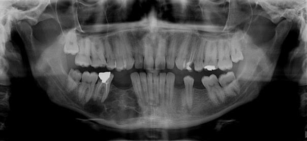 76 Pathological Fracture Following Treatment Of Odontogenic Myxoma multiloküler görüntü verirler. Multiloküler lezyonlar sabun köpüğü, tenis raketi veya bal peteği olarak da tanımlanırlar.