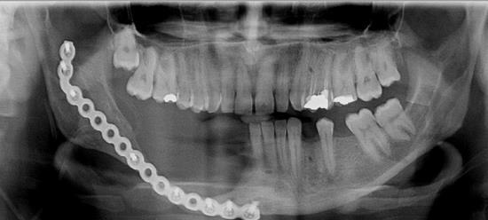OLGU 27 yaşında erkek hasta İstanbul Üniversitesi Diş Hekimliği Fakültesi Ağız, Diş ve Çene Cerrahisi Anabilim Dalı na sağ mandibula posteriorda dişetlerinde çekilme şikayeti ile başvurmuştur.