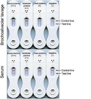 Lateral Flow Device (LFD) İmmunkromotografi prensibini kullanmakta Aspergillus taraˆndan salgılanan glikoproteine karşı oluşturulmuş monoklonal an@koru (JF5 IgG3) kullanmakta