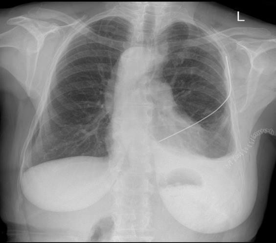 Effüzyon ve seroma drene edildi. Ancak olgu postoperatif dördüncü ayda solunum yetersizliği ve sepsis nedeniyle kaybedildi. Rezeksiyonda yapılan 10 (%52) olguda rekonstrüksiyon uygulandı.