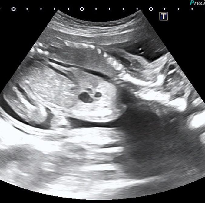 238 olca Topal ve Candan NOKT görülme sıklığı daha fazladır (Resim 3-C, Resim 4, ). kciğer kitlesi olan olan bir fetüste peritanal survi tahminindeki en önemli faktör fetal hidropsun olup olmamasıdır.