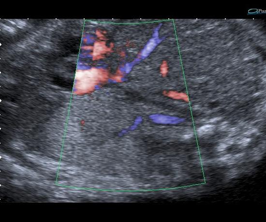 Fetal Torakal nomaliler 239 Resim 5.,. PS. Sol akciğer alt lobunda hiperekoik kitle () ve abdominal aortadan ayrılan arteri () Resim 6.,. Hibrid kitle.