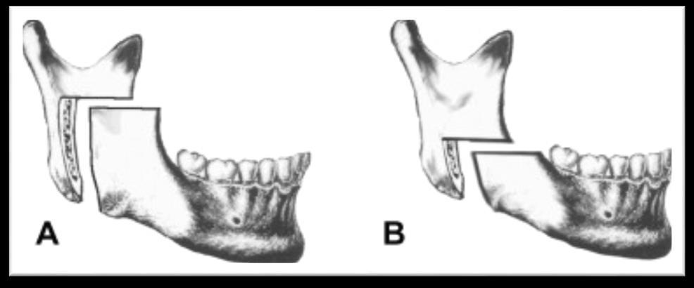 15 Bu işlemlerden sonra distal segment geriye çekilerek uygun oklüzyonda İMF sağlanır.