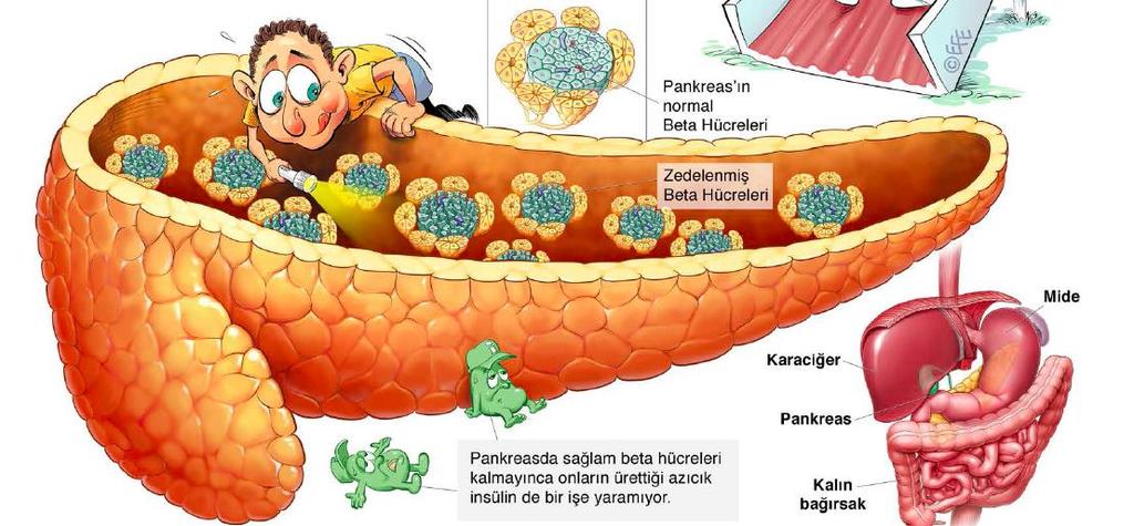 Çocuklarda Tip 1 diyabet Genetik yatkınlık Enfeksiyon hastalıkları gibi başlatıcı bir neden Otoimmün inflamasyon sonucu ilerleyici beta