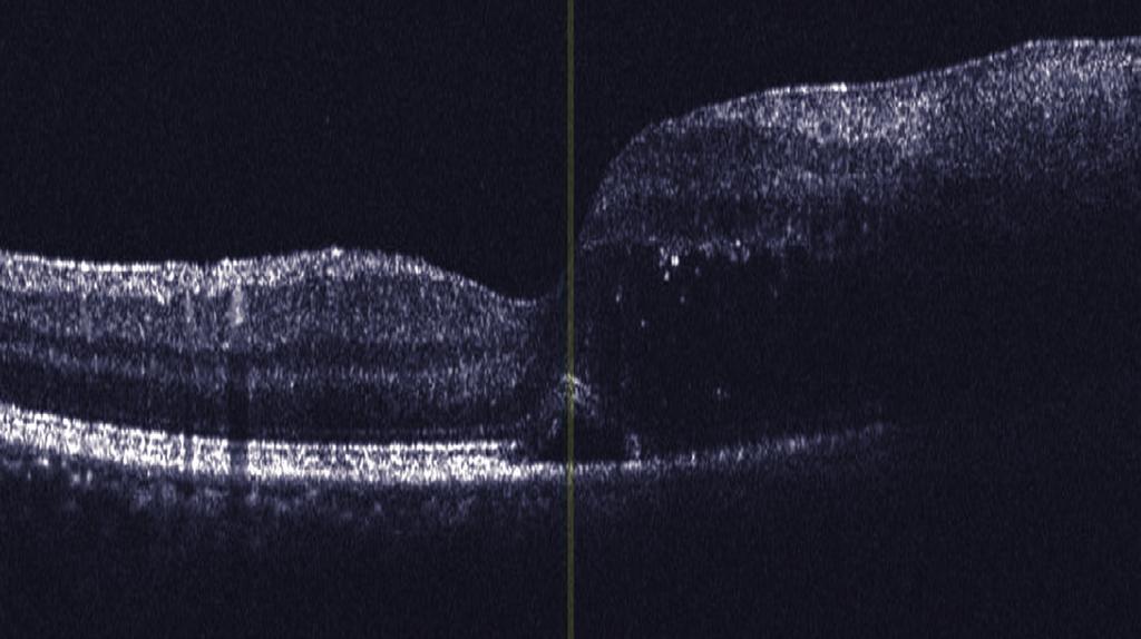 142 Tıkayıcı Vaskülitle Seyreden İki Sekonder Frosted Branch Angiitis Olgusu Resim 1a-c: Olgu 1; sağ göz alt temporal kadranda FBA görünümü (a,b), sağ göz FFA da tüm retinal venüllerde damar duvarı