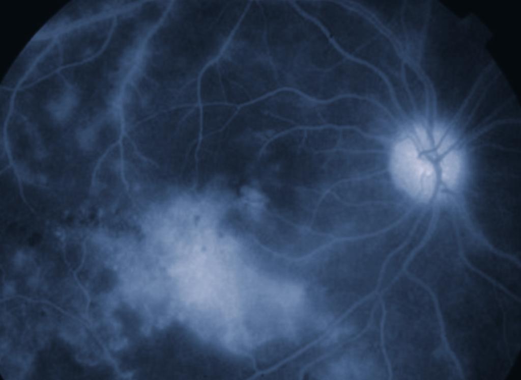Retina içi kanama ve retinal arteriol ve venül boyunca yerleşmiş eksüdasyon klasik FBA tablosunu oluşturmaktadır. Optik disk şişmesi çok sık olmamakla birlikte görüldüğü vakalarda genellikle hafiftir.