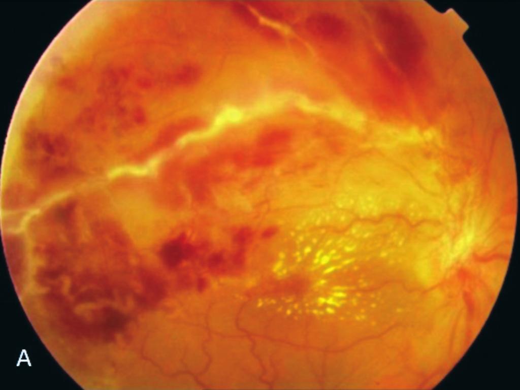 144 Tıkayıcı Vaskülitle Seyreden İki Sekonder Frosted Branch Angiitis Olgusu Resim 4a,b: Olgu 2; Üst temporal retina ven dal tıkanıklığı, optik diskte neovaskülarizasyon, makular star görünümü (a),