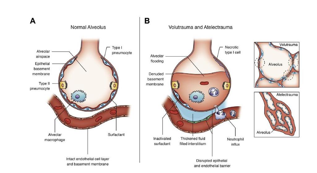 b VALI-Patofizyoloji Alveollerin zedelenmesine bağlı olarak progresif yüksek geçirgenlikli interstisyel ve